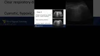 Pneumothorax Life Saving #POCUS #emergencymedicine #pulmonarymedicine