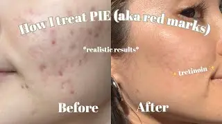 How I treat the PIE (aka red marks) on my cheeks | Tretinoin tips | Products I used