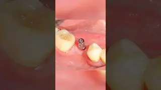 Implant level Closed Tray Impression | #lifeofadentalpractitioner #implantdentistry 🦷❤️