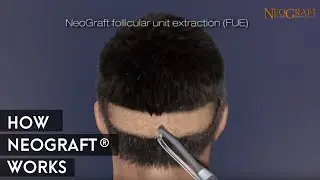 Animation on How NeoGraft&reg; Works