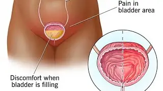 CLASS 46: BLADDER PAIN SYNDROME, URINE RETENTION, ACUTE UTI