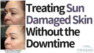 How to Treat Sun-Damaged Skin Like Dark Spots and Freckles, Without the Downtime