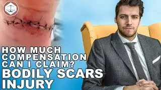 Bodily Scars Injury Compensation Claims Amounts? ( 2021 ) UK
