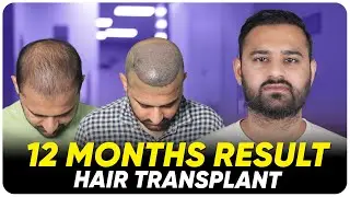Hair Transplant in Thailand | Best Results & Cost of Hair Transplant in Thailand