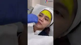 Yellow Peel | Effective For Acne Scars & Pigmentation