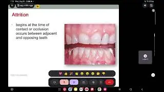 Hard tooth tissue reduction