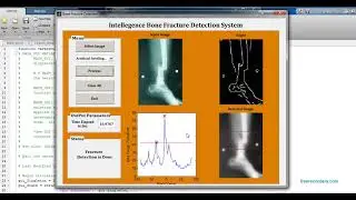 Bone Fracture Detection MATLAB code | MATLAB project