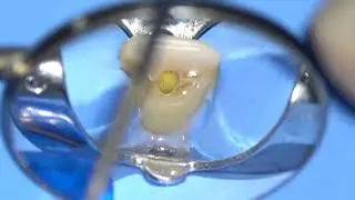 Apertura 21 perfect Endo
