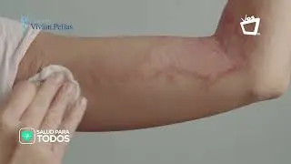 La lepra || SALUD PARA TODOS