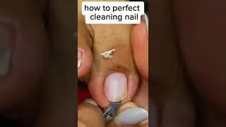 Procedure in removal toenail 