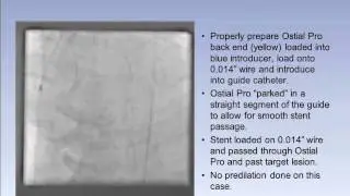 Ostial Pro&reg; Stent Positioning System Left Main #1 Case Study