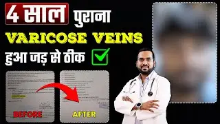 varicose veins की Best recovery | 4 साल पुराना वैरिकोज वेन्स हुआ जड़ से ठीक
