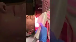 Sciton BBL Skin Tightening for Neck  - Avalon Laser - Dr. Reza Tirgari