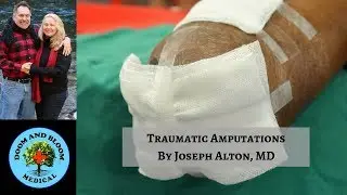 Amputation Injuries in Off Grid Survival Scenarios