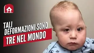 Mio figlio ha una deformazione al cranio: la storia di Tania | Essere mamma