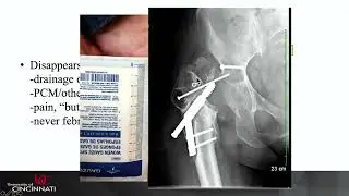 Fracture-Related Infection: Current Treatment Algorithms - Michael J. Beltran, MD