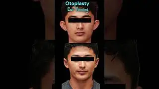 Otoplasty or ear pinning surgery in Los Angeles #bigears #dumboear #earpinning #cosmeticsurgery