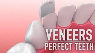 Dental Veneer Expert Gordon Dental / Kansas City / Leawood / Overland Park Kansas