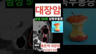 대장암 CT 진단 apple core sign