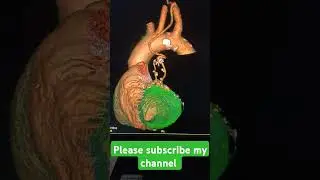 bypass surgery of heart after coronary angiography 3D heart image #podcast #tag doctor #radiology
