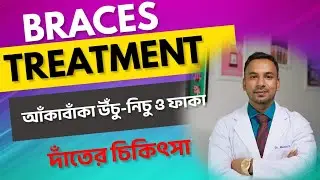 আঁকাবাঁকা ও উঁচুনিচু দাঁতের চিকিৎসা | Treatment for misaligned or uneven teeth | Dr. Manirul Islam
