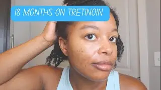 18 MONTH Update on TRETINOIN, Clindamycin/Benzoyl Peroxide, & Topicals Faded (Before & After Photo)