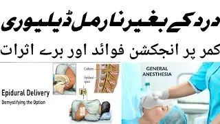 General Anesthesia And Epidural Steroid Injection | Painless Delivery Benefits And Side Effects