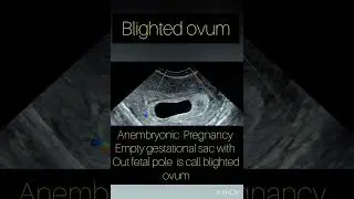 Ultrasound showing Blighted ovum! Anembryonic Pregnancy on ultrasound!#trendingshorts#youtubeshorts