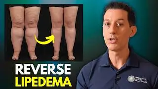 How to Reverse Lipedema