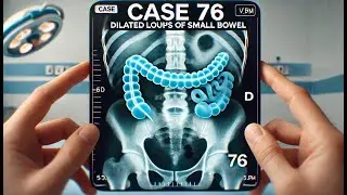 Case 76 dilated loops of small bowel