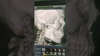 #ct scan face 3d image#