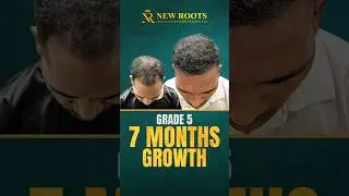 Grade 5 Baldness Success | 7 Months Hair Transplant Result in Raipur #hairtransplant #shorts