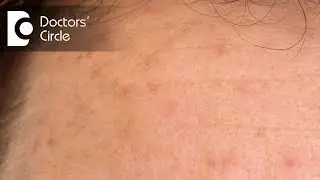 What is Hyperpigmentation and how to treat it? -  Dr. Jyoti Jha