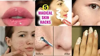 5 Magical Beauty HACKS Using TOOTHPASTE l Pimples,Dark Spots,Pink Lips, Blackheads Whiteheads l Tips
