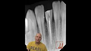 Coronal Gutta Percha Removal