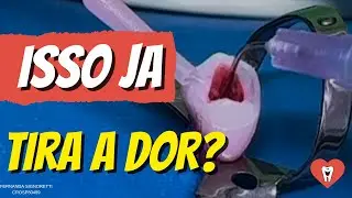 ENDODONTIA: COMO RESOLVER DOR EM MENOS DE 30min? - Endolovers 