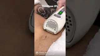 IPL Hair Reduction with SkinBase. Men get those chests smooth and hair free #hairremoval #ipl