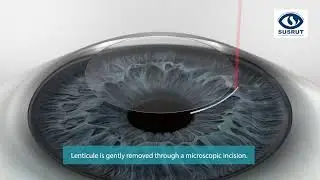 ELITA SILK Animation for Patients Education | Susrut Eye Foundation