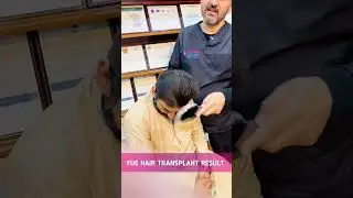 FUE Hair Transplant Result || Perfect Result || Dr. Habib Ullah Shah #hairtransplantinpakistan