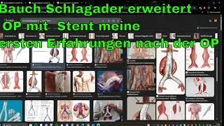 Bauch Schlagader erweitert OP mit  Stent meine ersten Erfahrungen nach der OP