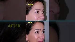 Does Transplanted Eyebrow Hair Grow Long?