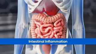Medical Animation - Intestinal Inflammation