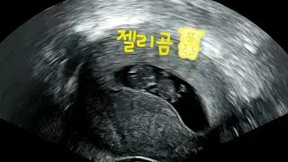 ♡다이아 9주차 5일(태아 초음파)  초코우유 먹은 태아의 움직임