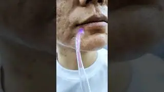 Is the high frequency wand worth it?#acne#facialproducts#darsonval#backtoschool#beauty#skincaretips