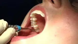 Hu-Friedy Nevi 3 & 4 Posterior Scalers