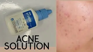 #acnesolution Acsolve lotion honest review 💯 magically removing acne
