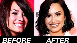 HOW I CLOSED MY GAP WITHOUT BRACES!