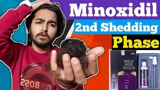 Minoxidil 2nd Shedding Phase | Ghabrana Mat