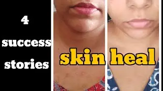 SKIN HEAL SUCCESS STORY 💪 CIRCUMSTANCES DO NOT MATTER #nevillegoddard #manifestmeditation #skincare