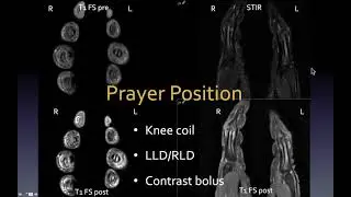 Arthritis: Role of MRI by Karen C. Chen, M.D.